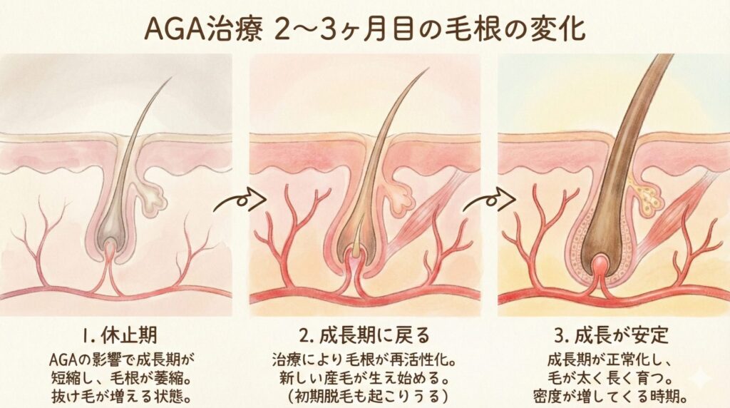 AGA治療2～3ケ月目の毛根の変化のイラスト
