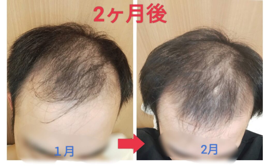 2か月後の頭皮比較写真