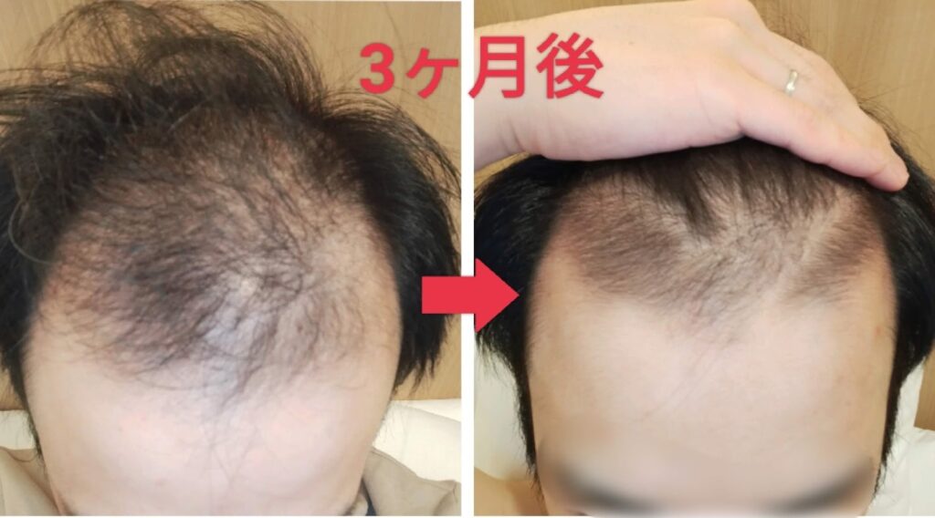 3ケ月目の頭皮比較写真