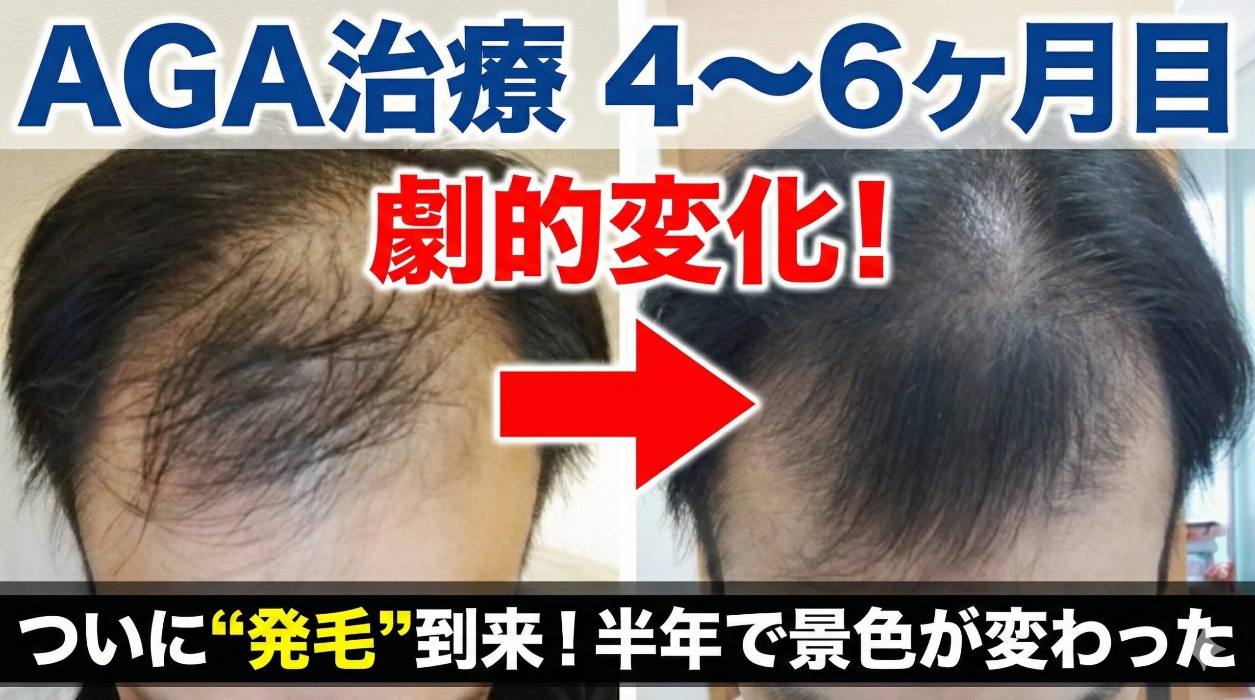 AGA治療比較アイキャッチ