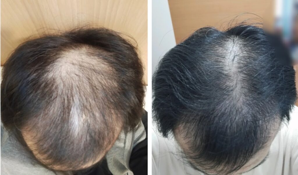 AGA治療6ヶ月後の比較写真