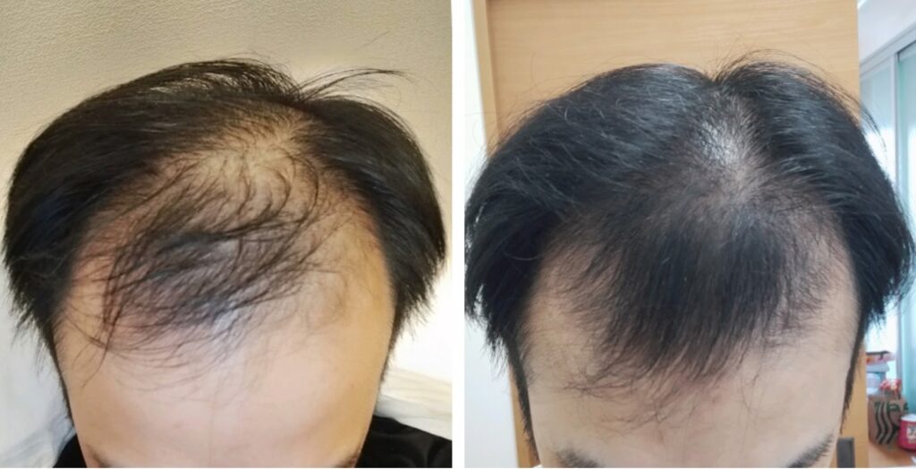 AGA治療6ヶ月後の比較写真