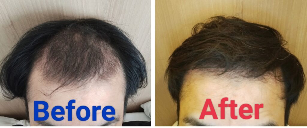 増毛パウダーのビフォーアフター画像