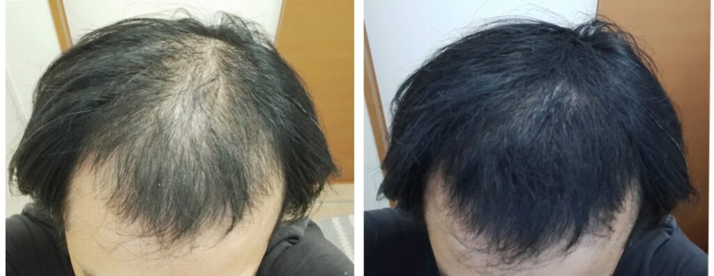 ミリオンヘアー使用前後の比較写真。左が使用前で頭頂部の地肌透けが目立つ状態、右が使用後で頭頂部が自然にカバーされた状態。