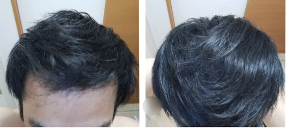 ミリオンヘアー使用後のスタイリング比較。両サイドの髪を被せてスプレーで固めた仕上がり。頭頂部の地肌がほぼ見えない自然な状態になっている。左が正面からで右が上からのアングル
