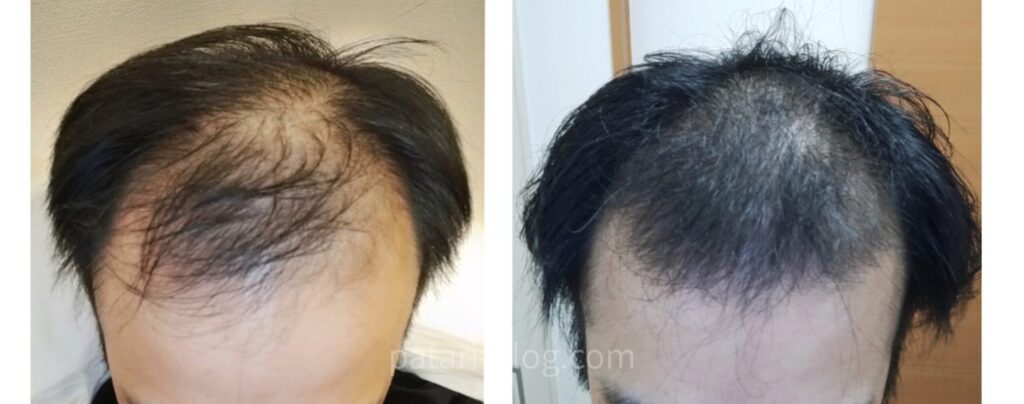 AGA治療前後の頭頂部比較写真。左は治療開始時で広範囲に地肌が見えている状態、右は治療継続後で髪の密度が増え、地肌の透け感がやや軽減している様子。
